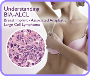 Breast Implant-Associated Anaplastic Large Cell Lymphoma