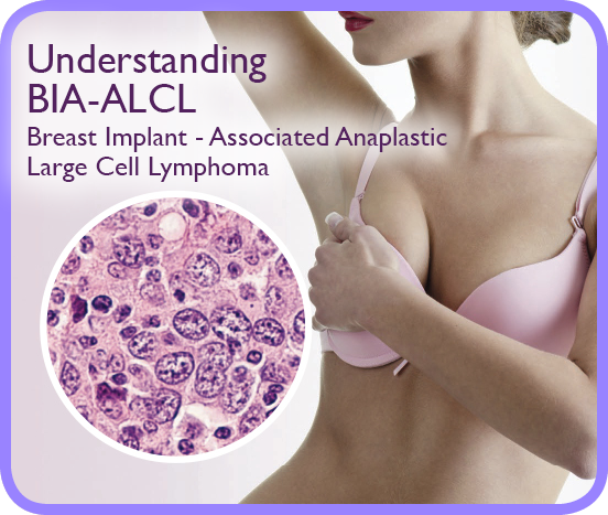 Breast Implant-Associated Anaplastic Large Cell Lymphoma (BIA-ALCL